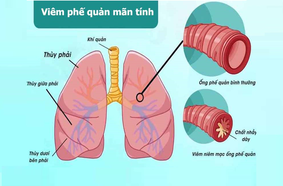 viêm phế quản mãn tính có chữa được không