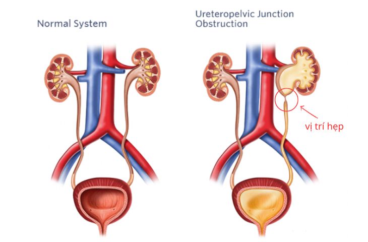 hep nieu quan than u nuoc