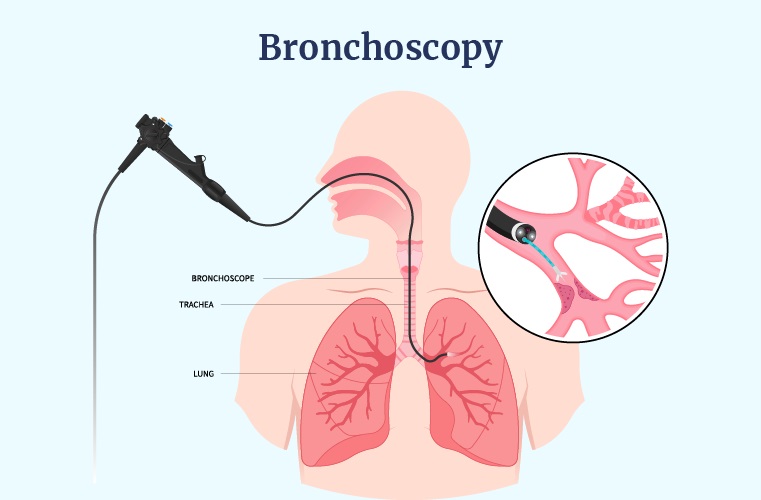 nội soi phế quản ở đâu uy tín