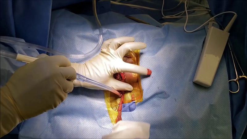 Tiến hành phẫu thuật loại bỏ áp xe