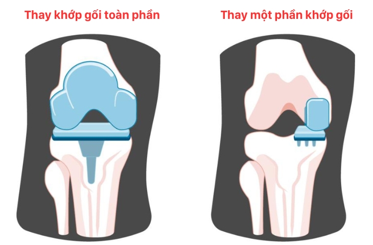 các loại khớp gối nhân tạo