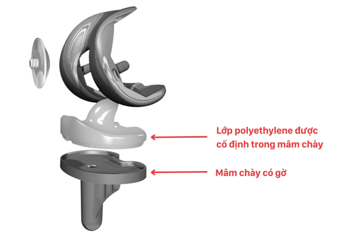 các loại khớp gối nhân tạo