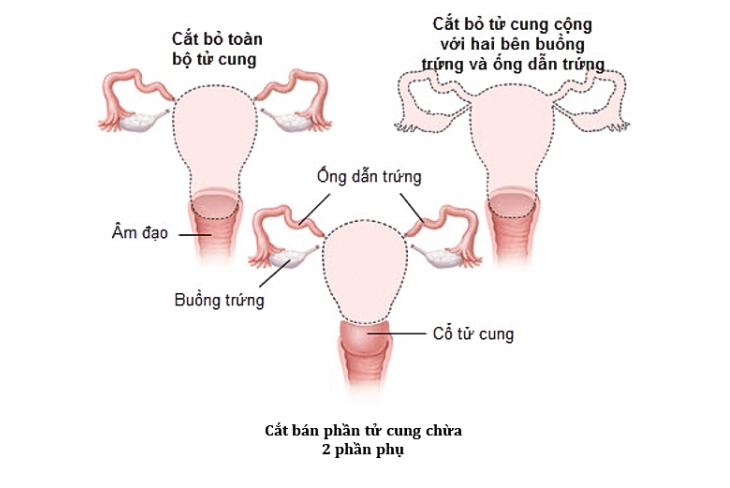 cắt tử cung bán phần