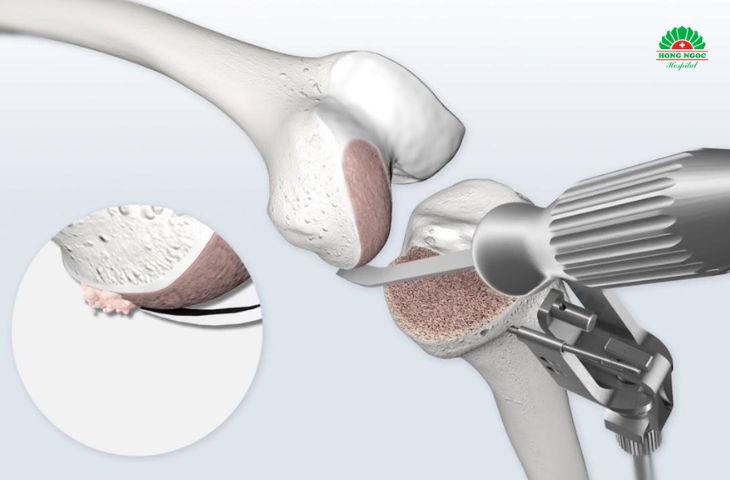 Chi phí thay khớp gối