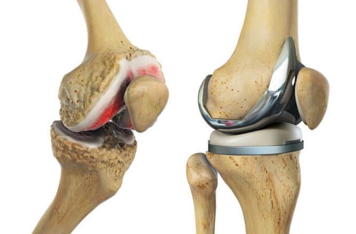 khớp gối nhân tạo