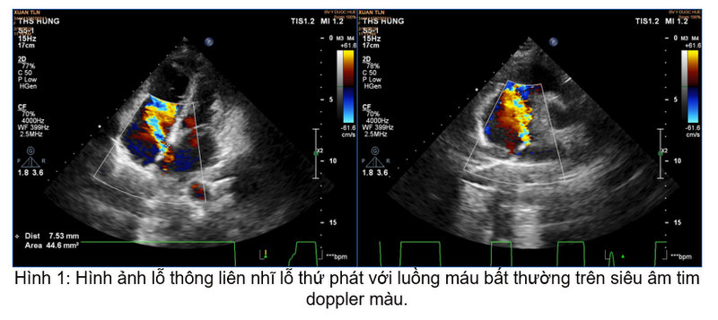 Siêu âm tim cơ bản giúp phát hiện bệnh lý thông liên nhĩ