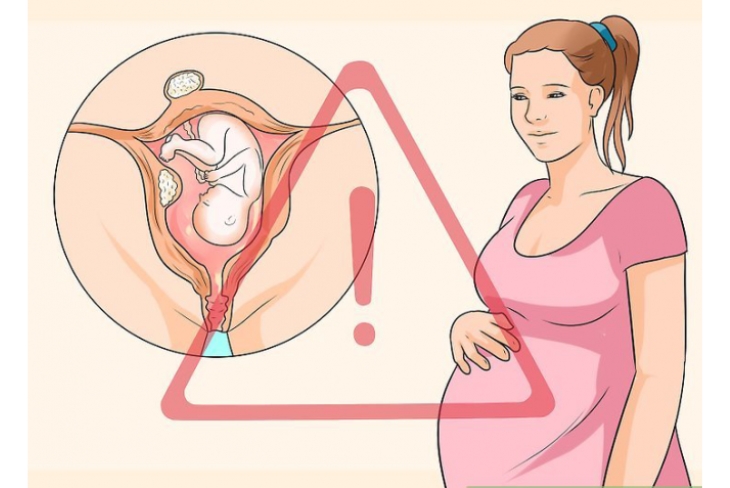 U xơ tử cung khi mang thai