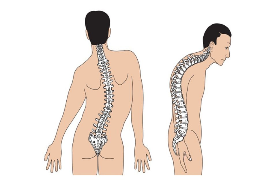 Phẫu thuật điều trị cong vẹo cột sống