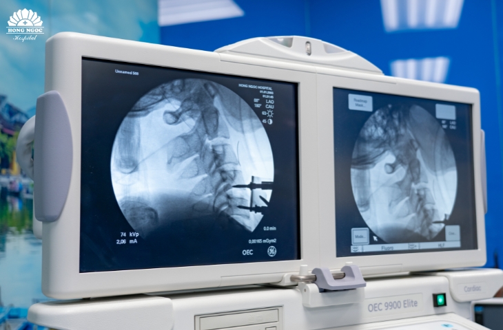 Phẫu thuật lấy đĩa đệm và nẹp vít cố định cột sống