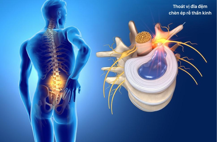 Phẫu thuật cột sống có thể áp dụng với bệnh nhân thoát vị đĩa đệm