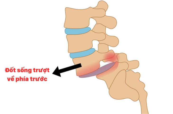 Phẫu thuật điều trị trượt đốt sống