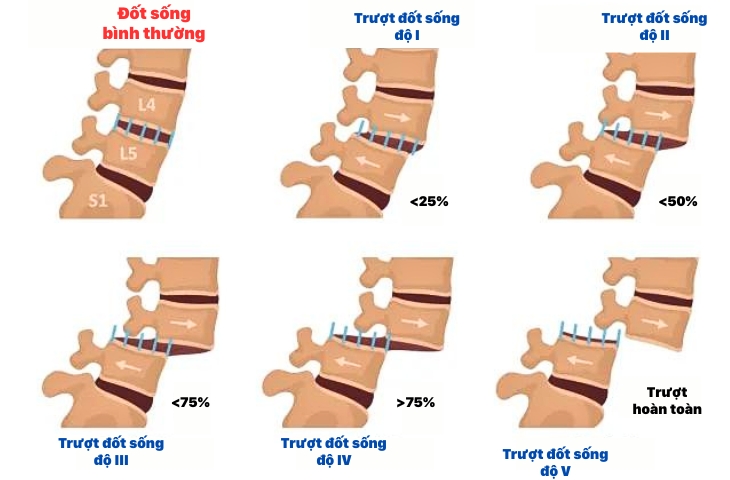 phẫu thuật điều trị trượt đốt sống