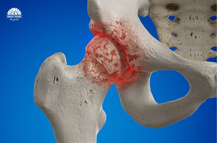 chi phí thay khớp háng