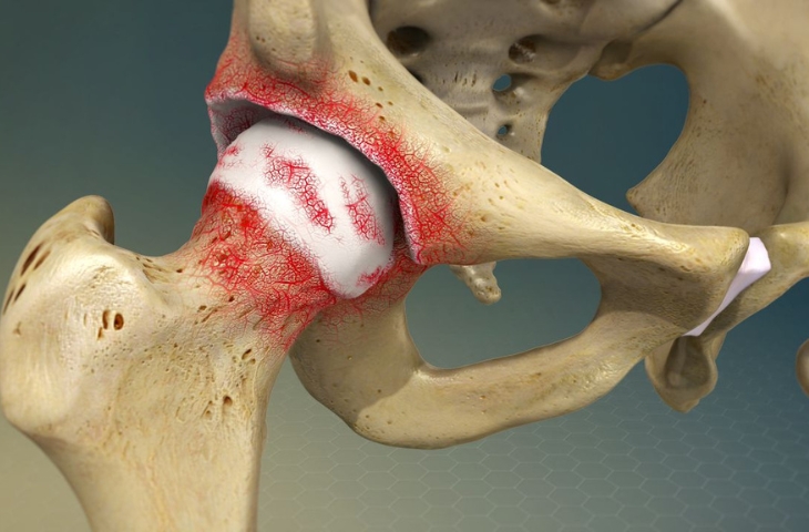 Thay khớp háng Thoái hóa khớp háng giai đoạn cuối được chỉ định phẫu thuật thay khớp háng.