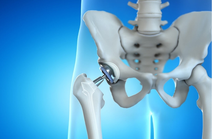 Thay khớp háng
