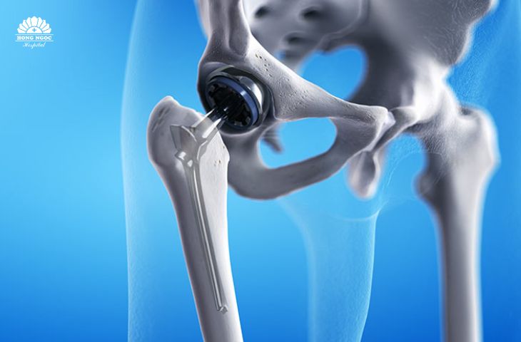 Chi phí thay khớp háng