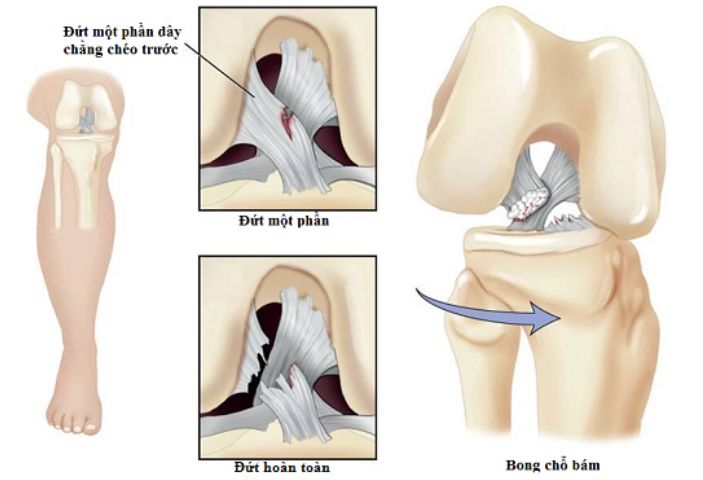Chi phí phẫu thuật dây chằng khớp gối