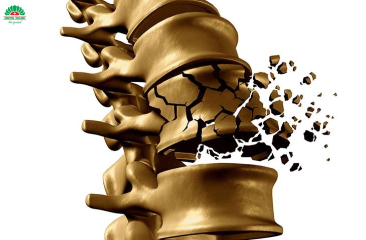 phẫu thuật điều trị gãy cột sống