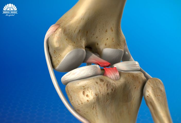 Tái tạo dây chằng chéo sau