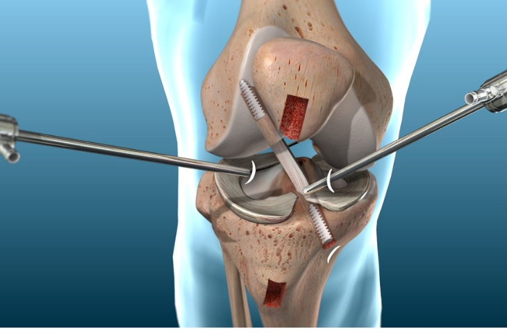 Phẫu thuật tái tạo dây chằng chéo trước.