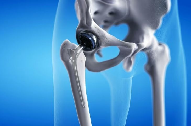 Thay khớp háng bán phần