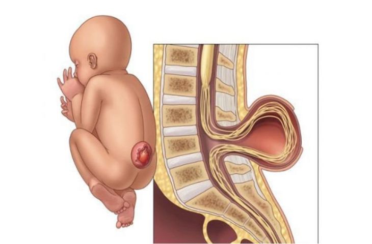 thoát vị màng não tủy