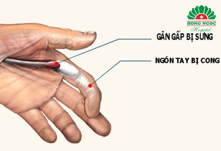 viêm gân gấp ngón tay