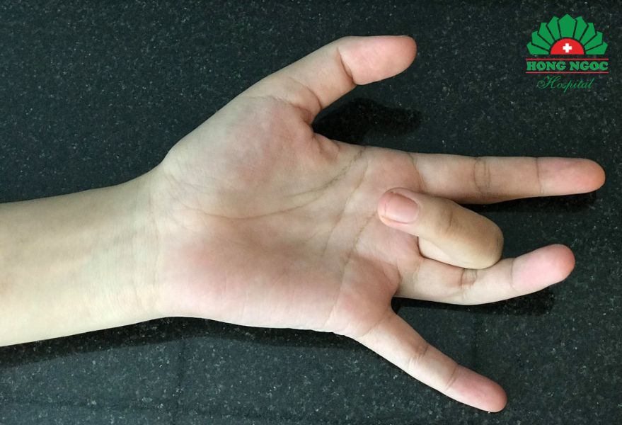 Viêm gân gấp ngón tay